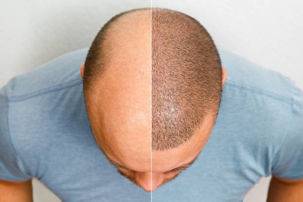 Hair transplantation by AestheMedLink in Turkey and United States